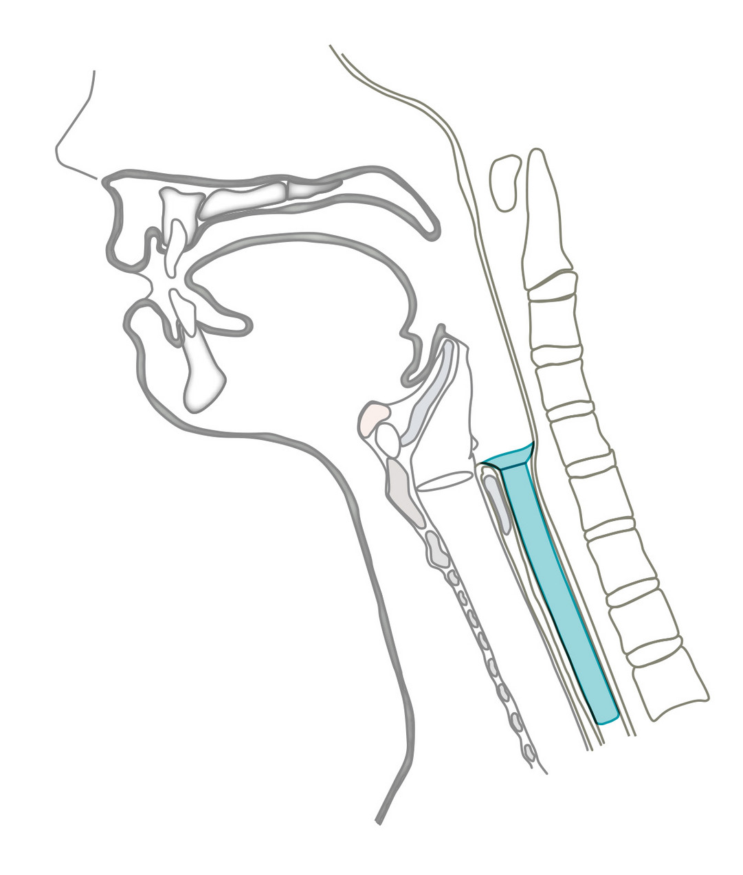 Montgomery® Salivary Bypass Tube Montgomery® Salivary Bypass Tube