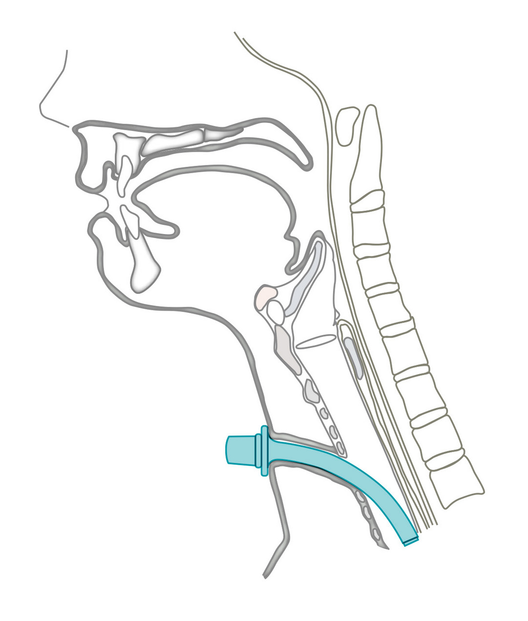 Moore Tracheostomy Tube Moore Tracheostomy Tube