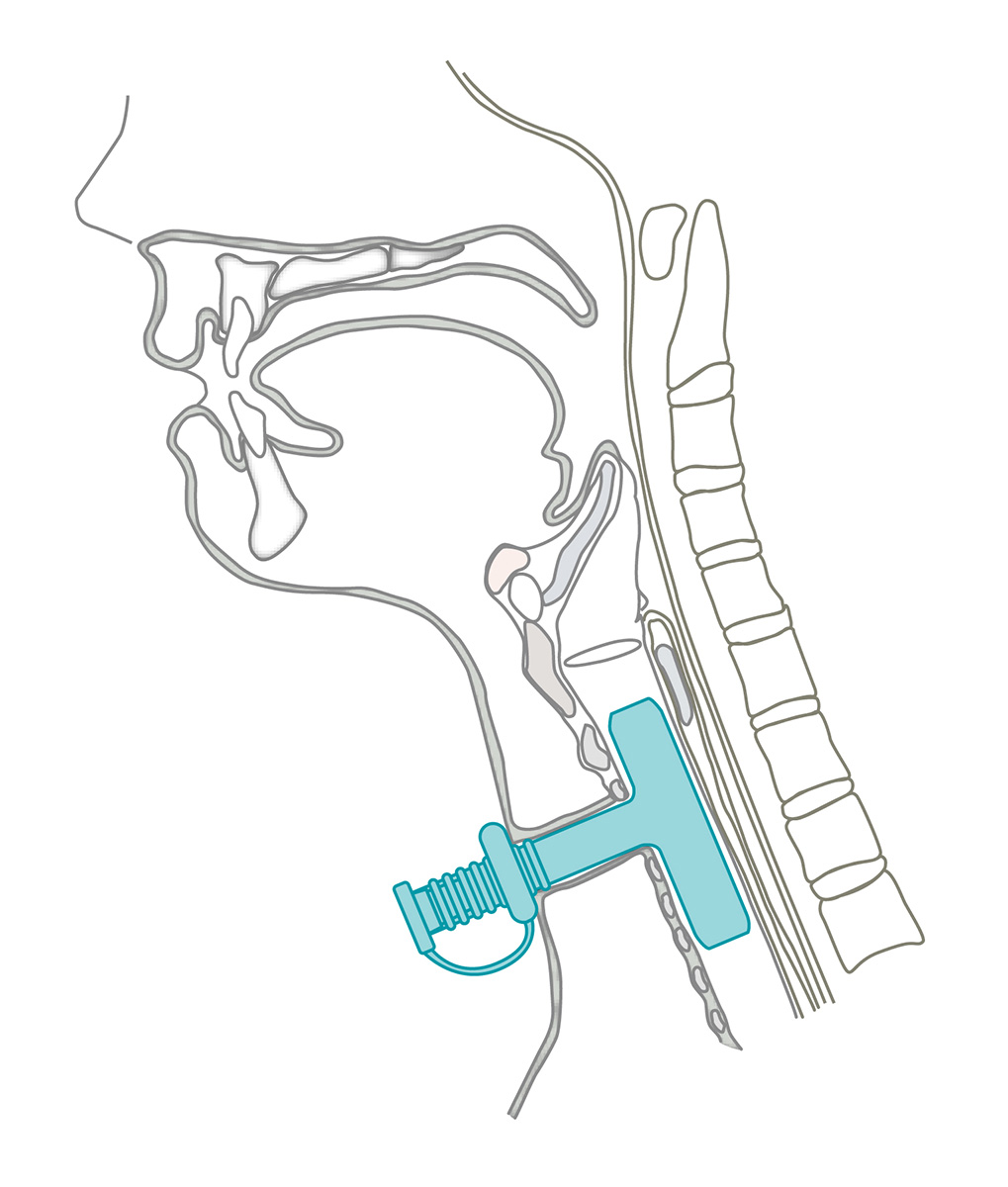 Montgomery® Safe-T-Tube™ Montgomery® Safe-T-Tube™