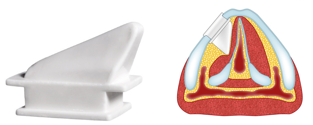 Montgomery® Thyroplasty Implant Montgomery® Thyroplasty Implant